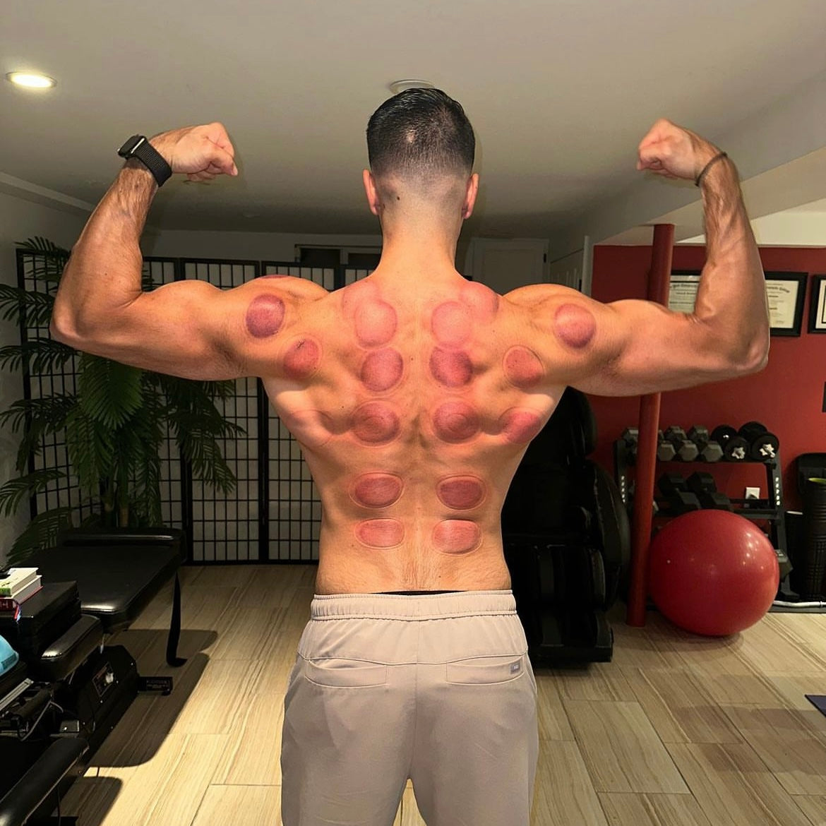 Smart Recovery Cupping Device