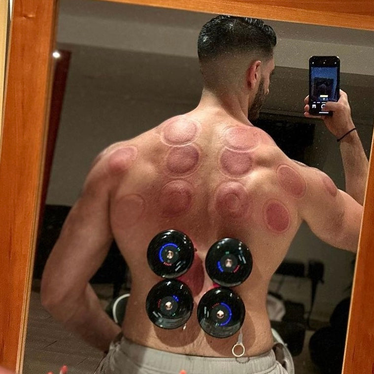Smart Recovery Cupping Device